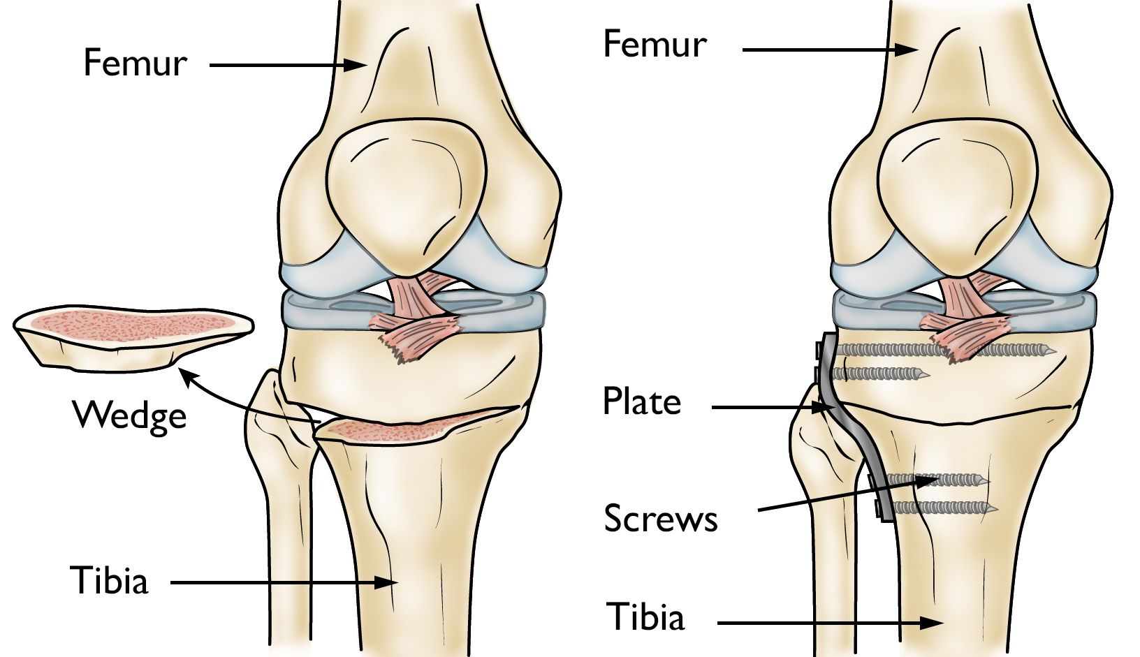 Osteotomy of the knee