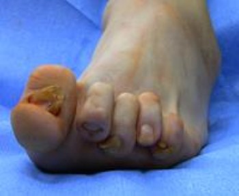 Arthritis of the Foot and Ankle - OrthoInfo - AAOS