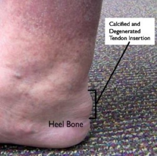 Achilles tendon deals and foot pain