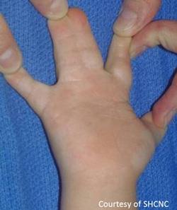 Syndactyly