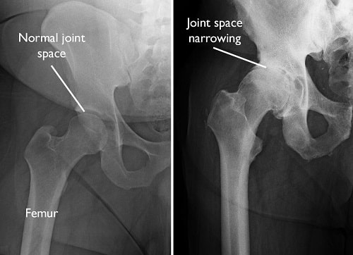 What Is Hip Osteoarthritis?