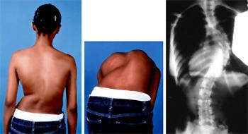 Escoliosis idiopática en niños y adolescentes (Idiopathic Scoliosis in  Children and Adolescents) - OrthoInfo - AAOS