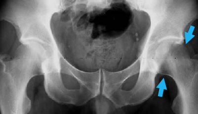 Pelvis x-ray