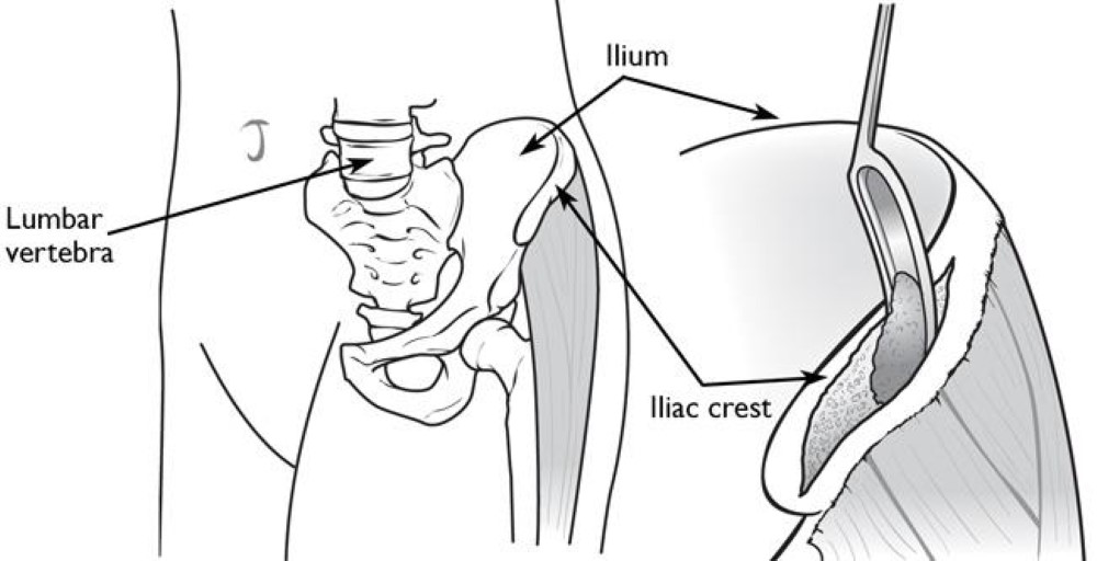 iliac crest bone graft