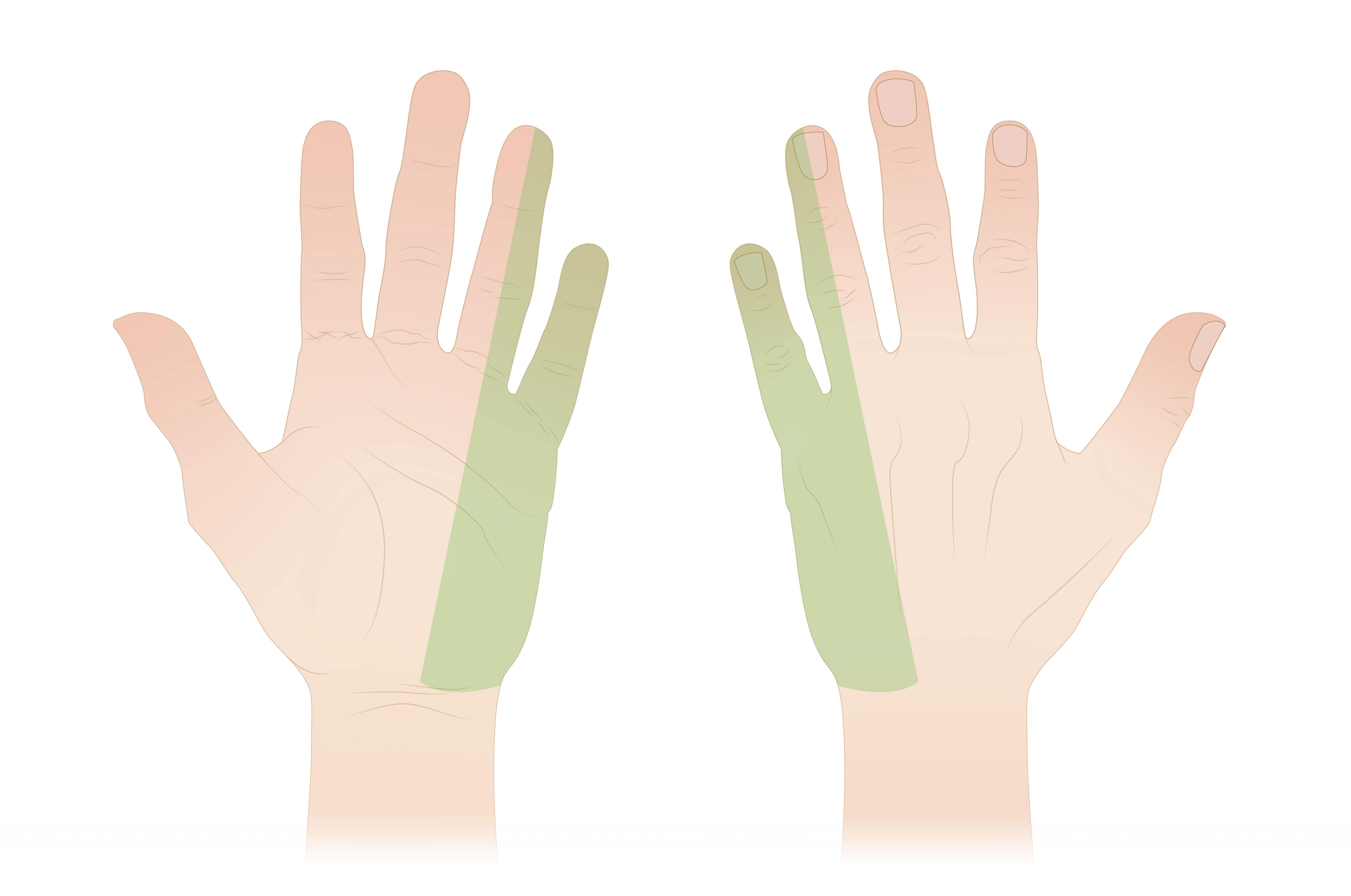 Orthobullets - This illustration shows the common potential sites of ulnar  nerve entrapment around the elbow.