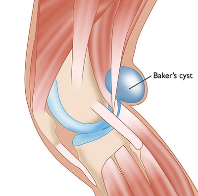 Baker's Cyst (Popliteal Cyst) - OrthoInfo - AAOS