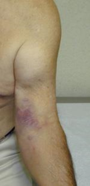Image result for biceps rupture
