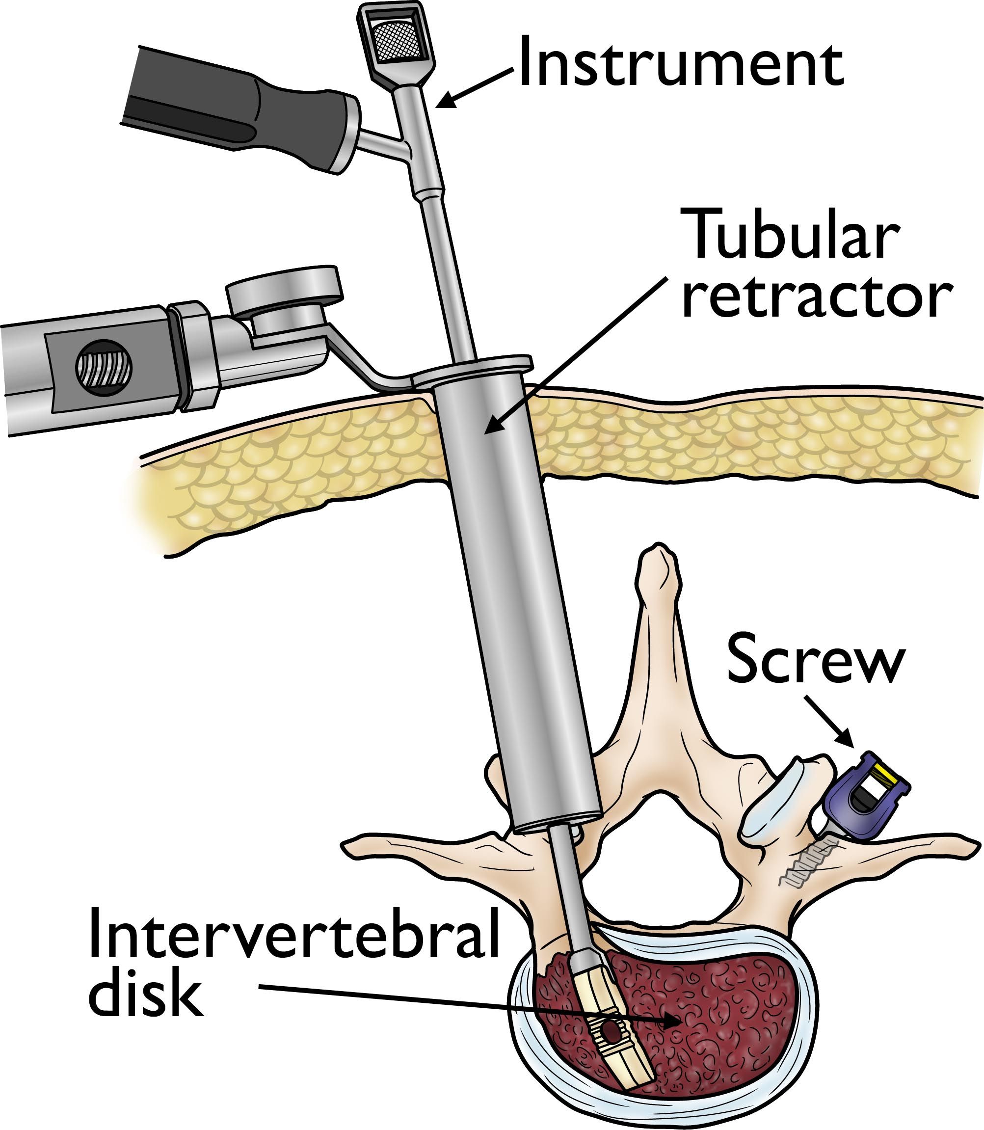 Lumbar Spinal Stenosis - OrthoInfo - AAOS