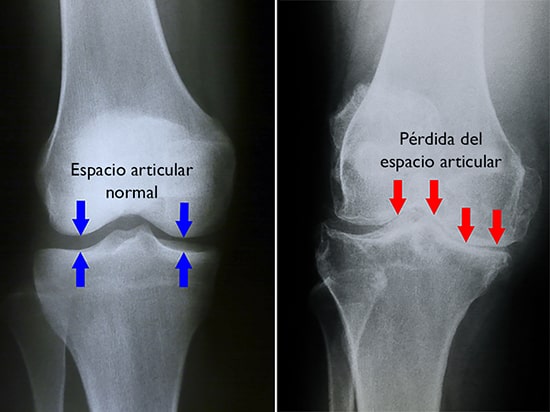 Cómo saber si tengo líquido en la rodilla: síntomas y diagnóstico