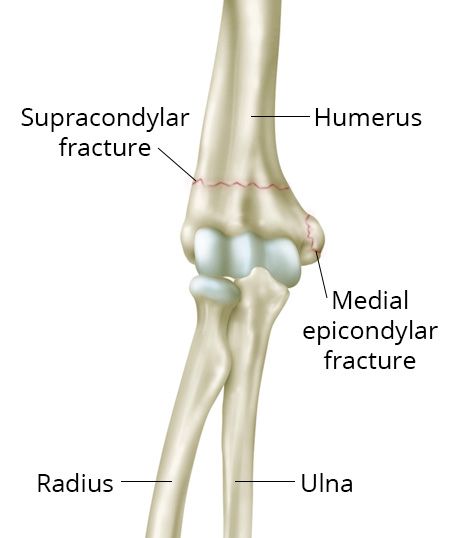 Types of elbow fractures