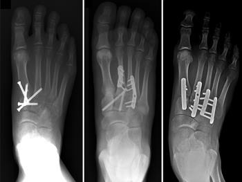 Internal fixation of Lisfranc injuries