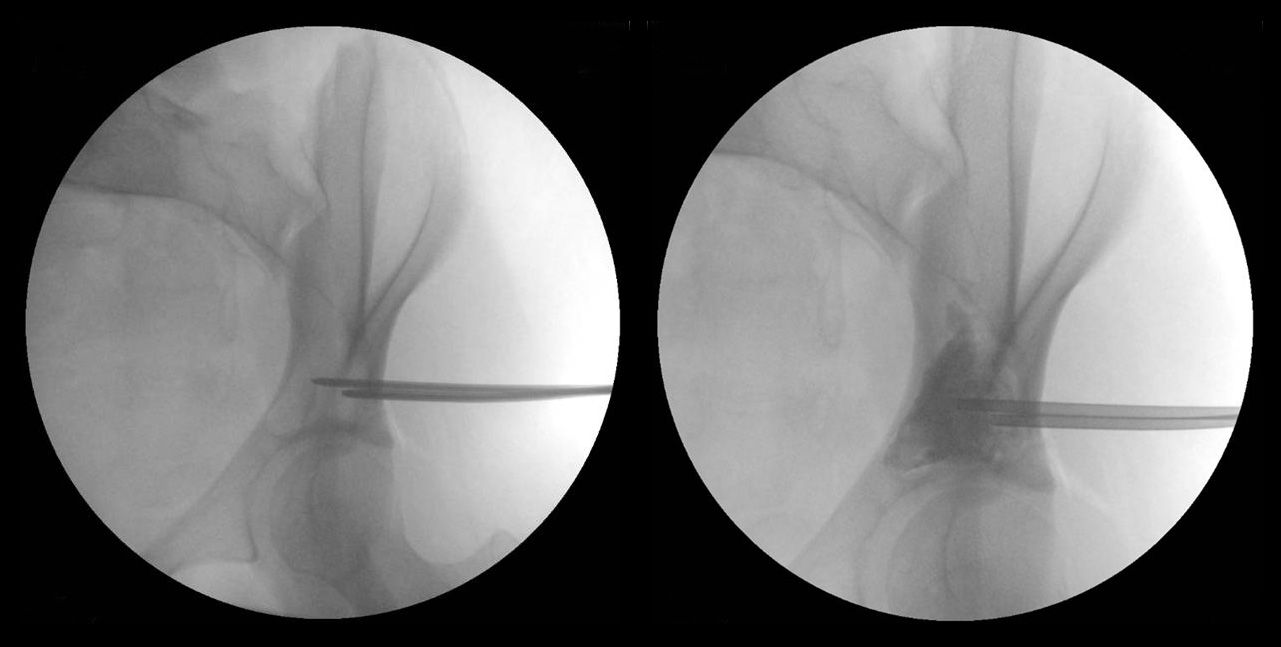 Aspiration of unicameral bone cyst