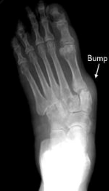 lump on 5th metatarsal