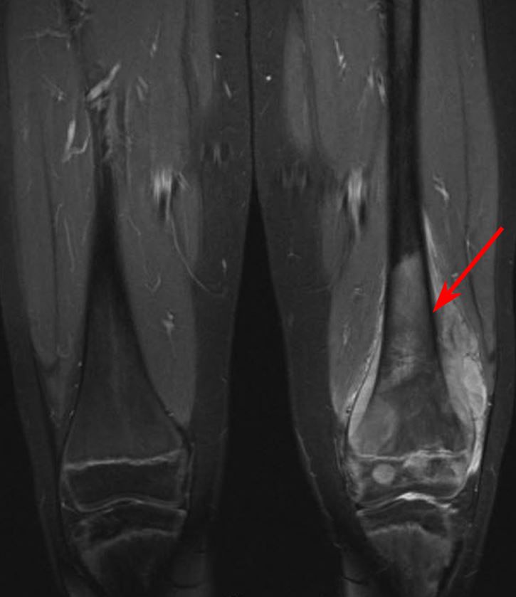 Resonancia magnética de osteosarcoma en el fémur