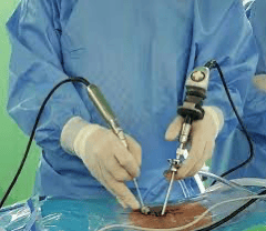 Endoscopic Minimally Invasive Spine Surgery