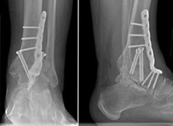 Ankle fusion