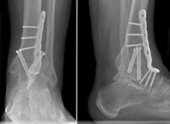 x ray hindfoot fusion