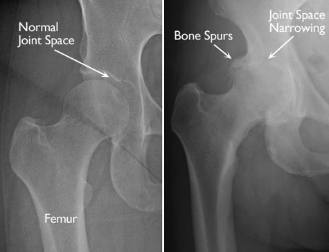 X-rays of a normal hip and an arthritic hip
