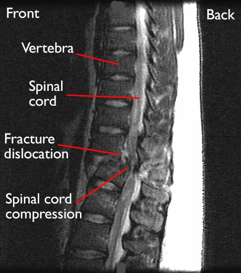 Fractures of the Thoracic and Lumbar Spine - OrthoInfo - AAOS