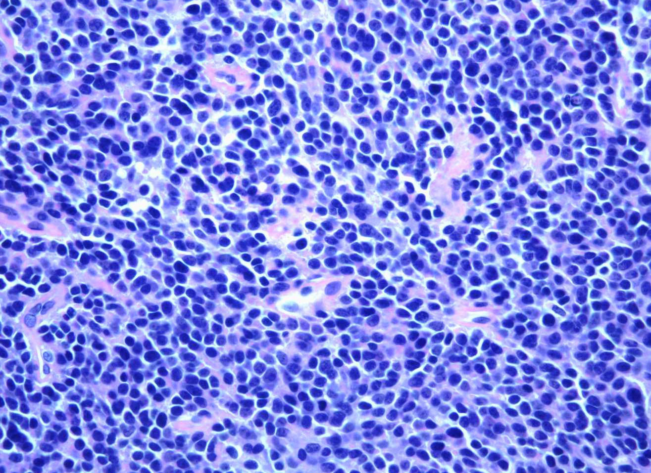 Ewing Sarcoma Under a Microscope