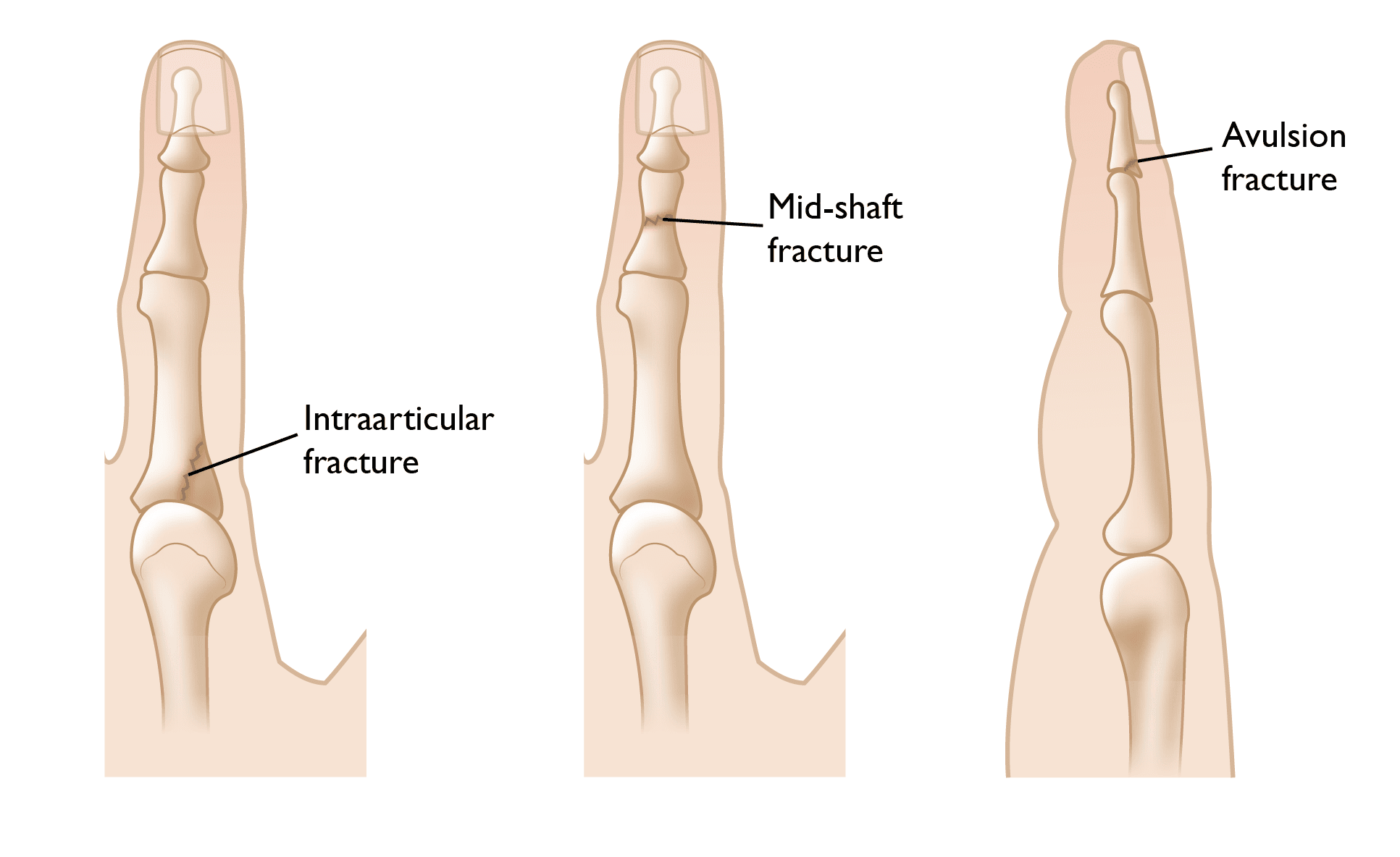 Types of Finger Fractures