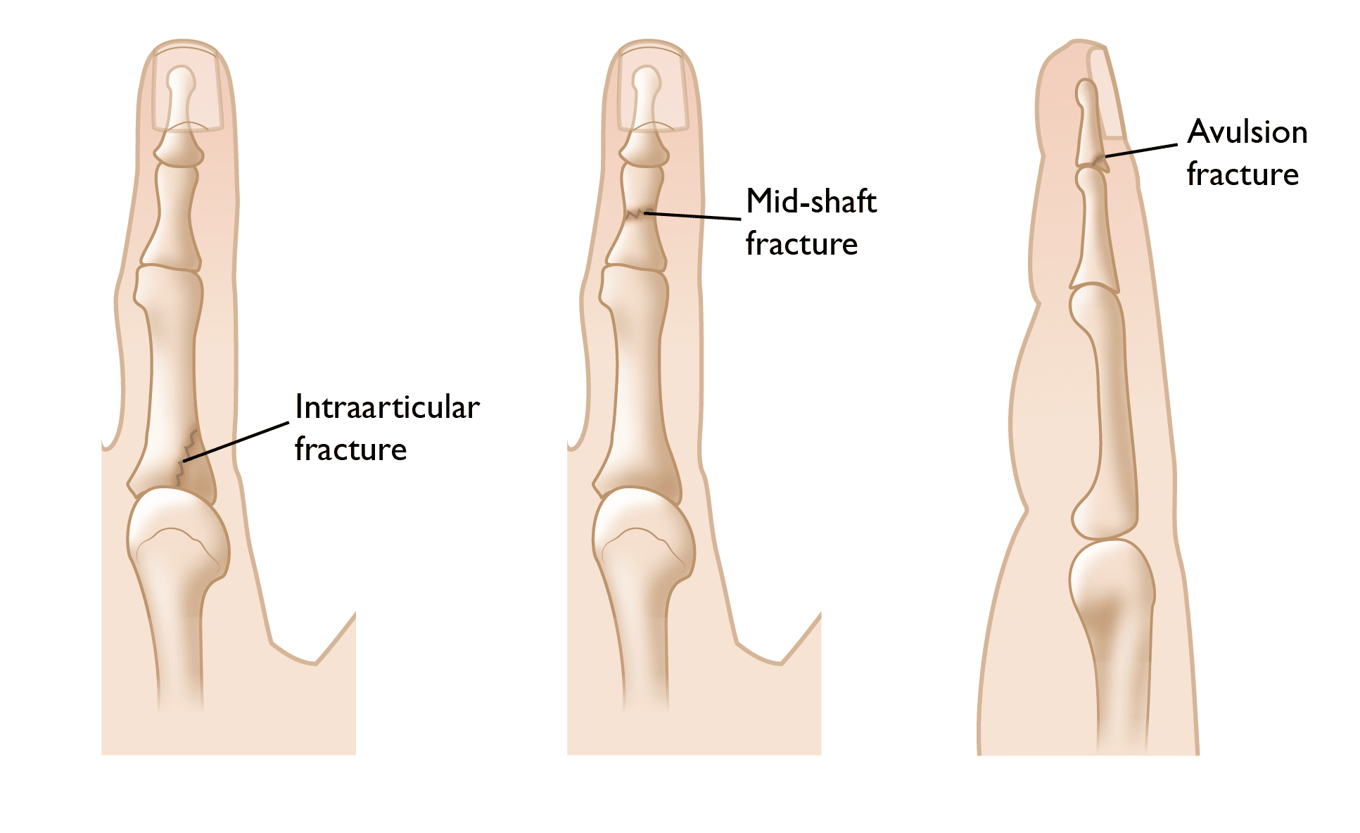 Finger Fractures OrthoInfo AAOS