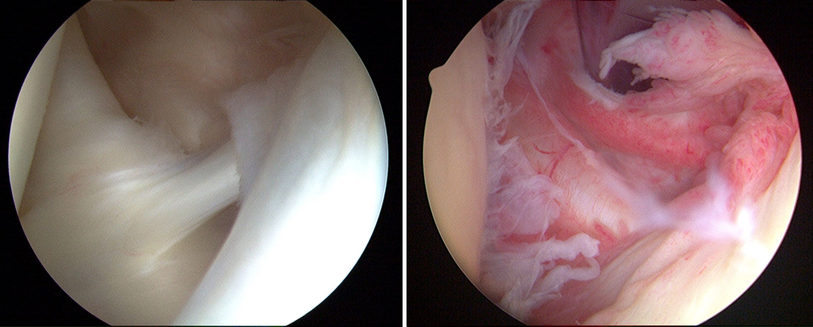 Arthroscopic photos of shoulder joint