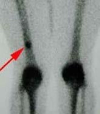 Bone scan