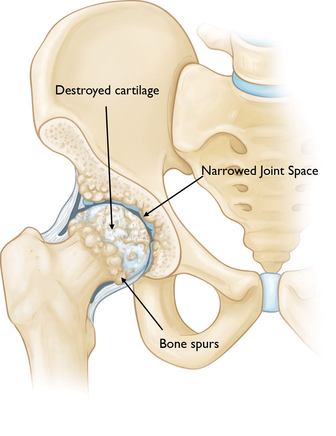 An osteoarthritic hip