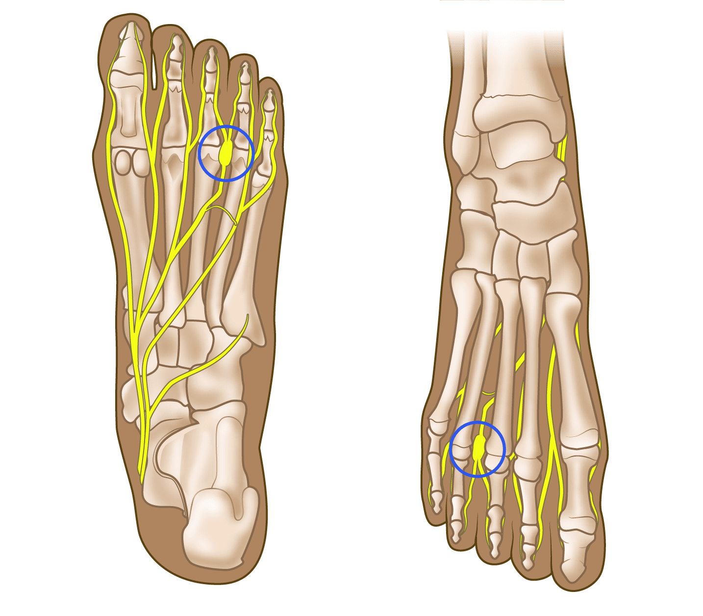 Shoe insert for hot sale morton's neuroma