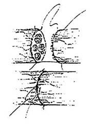 Nerve repair