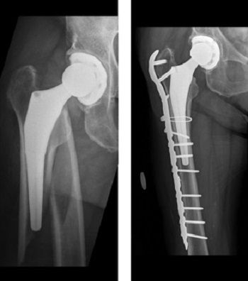 Fracture After Total Hip Replacement - Orthopedic & Sports ...