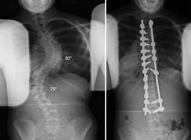 Escoliosis idiopática en niños y adolescentes (Idiopathic