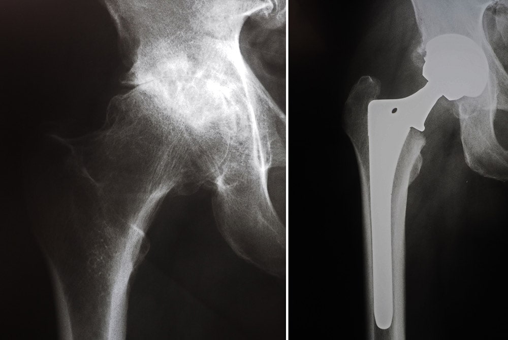arthritic hip and hip replacement
