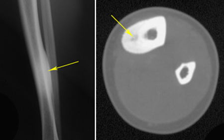 symptoms of osteoma