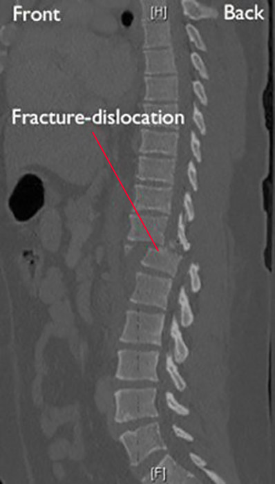 broken vertebrae x ray