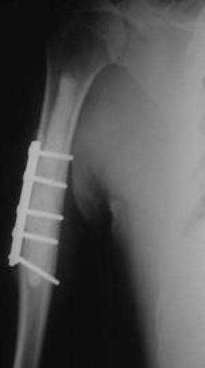 plate fixation of humerus