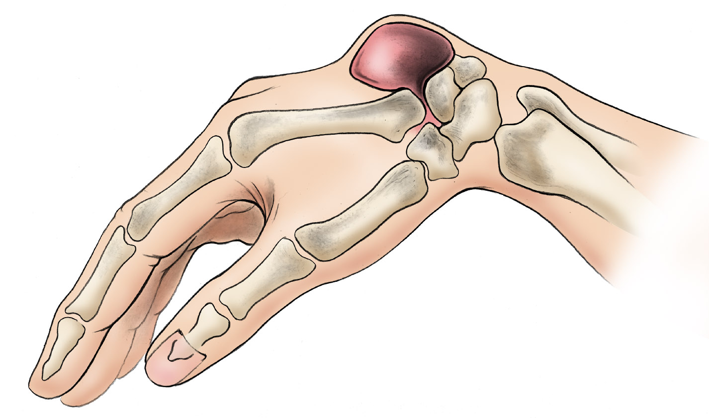 Ganglion cyst