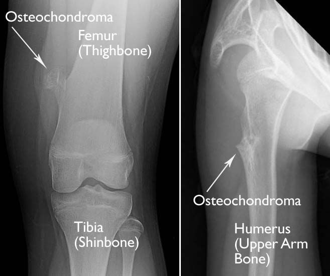 Osteochondroma - OrthoInfo - AAOS