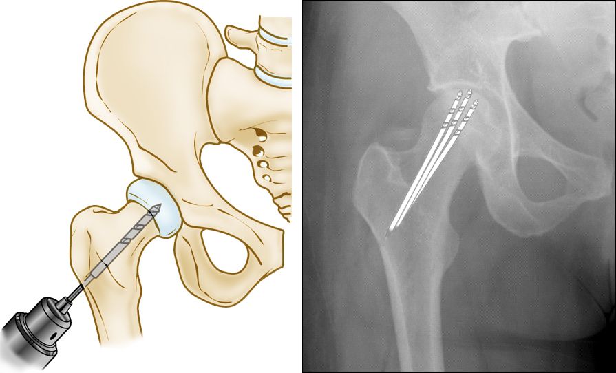 collapsed femoral head