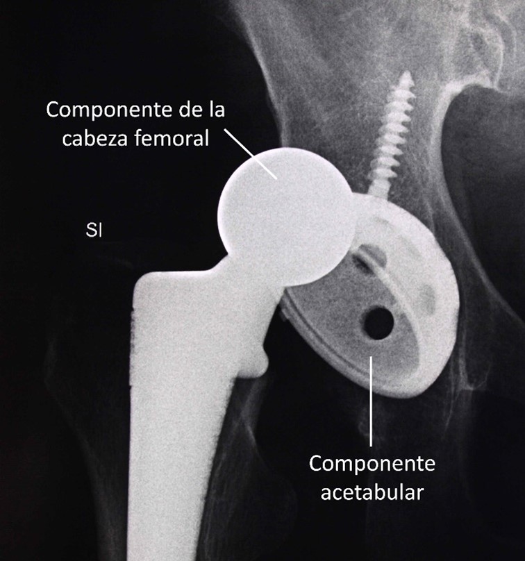 Dislocación De La Rodilla Care Guide Information En Espanol