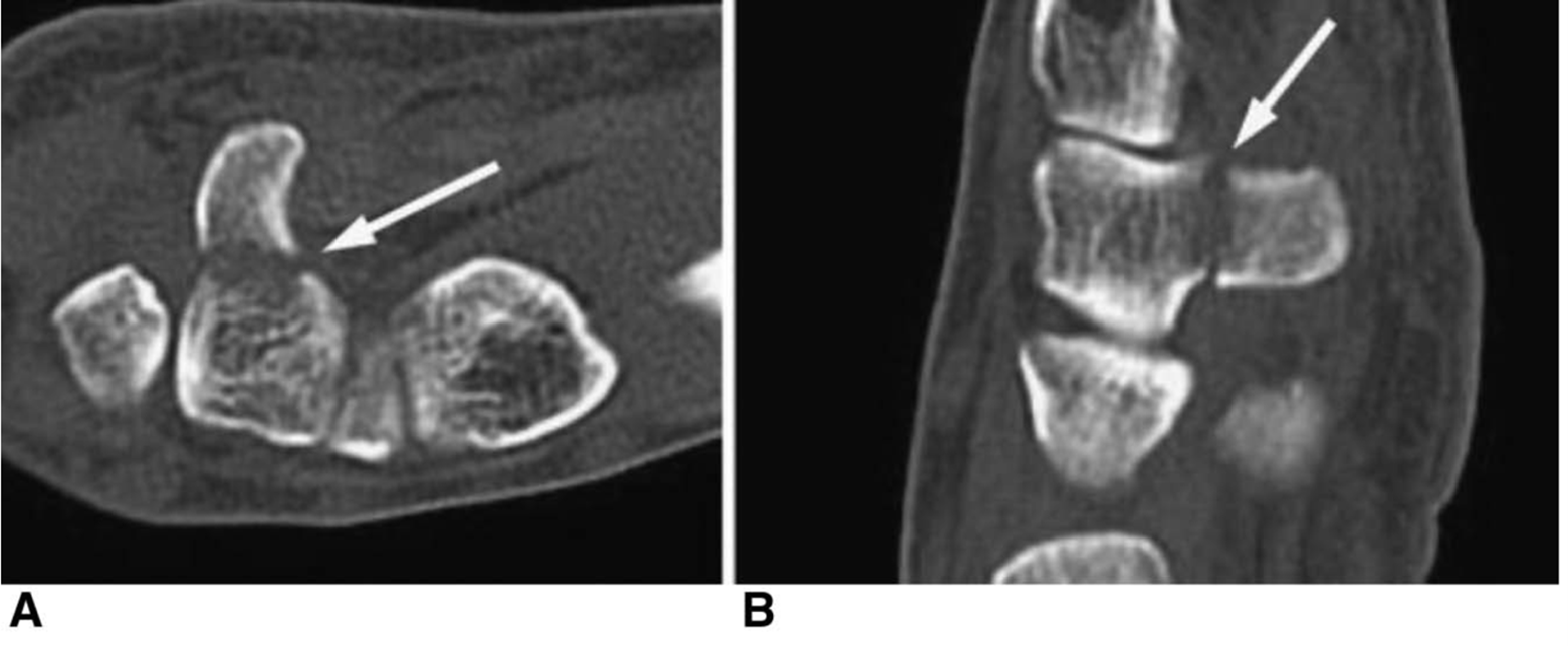 CT Scan of Hamate Fracture