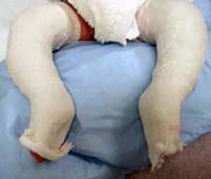 Ponset method for treating clubfoot