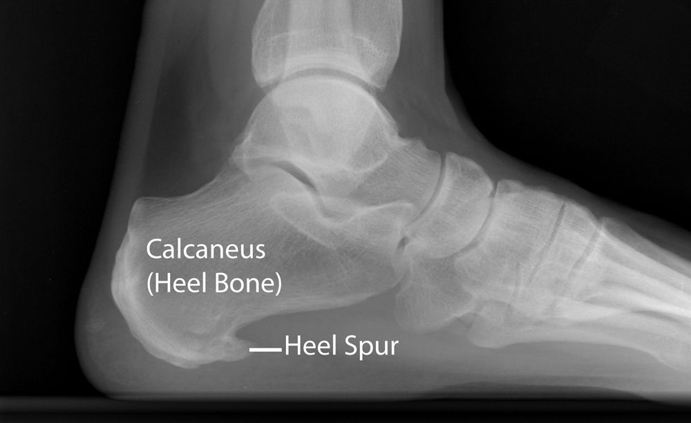 X-ray of heel spur