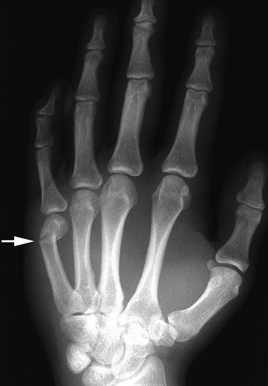 mild boxer fracture