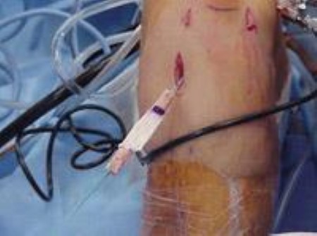 Management of ACL rupture