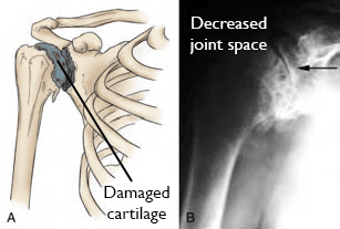Ilustración y radiografía que muestra osteoartritis del hombro