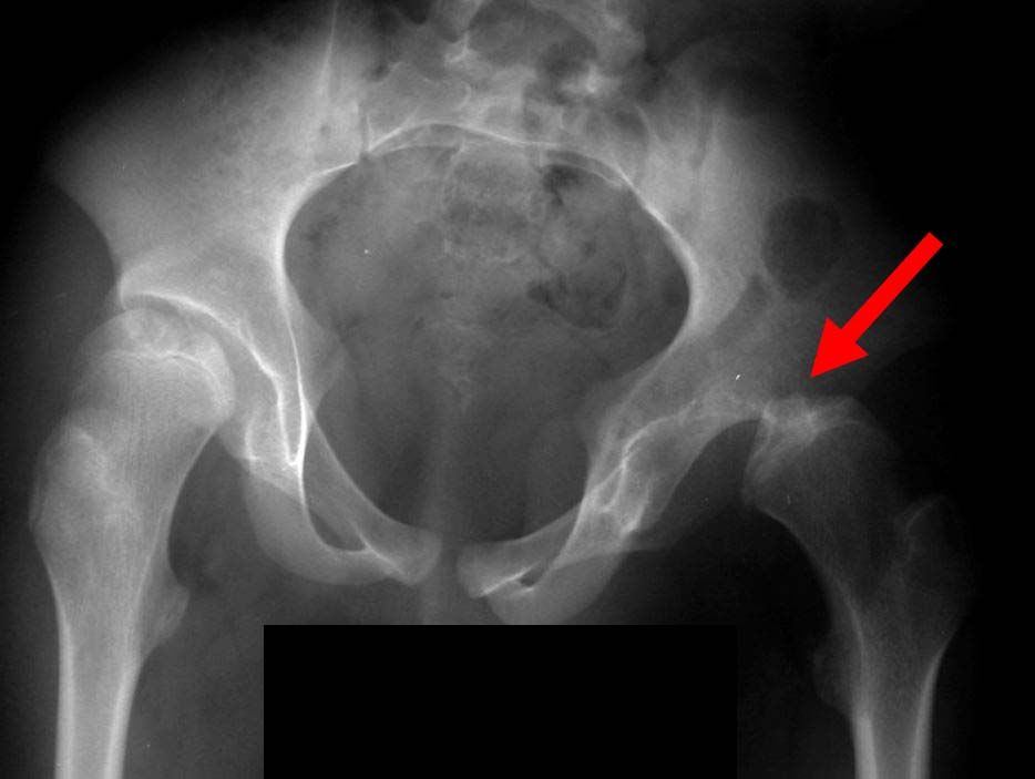 X-ray of dislocated hip