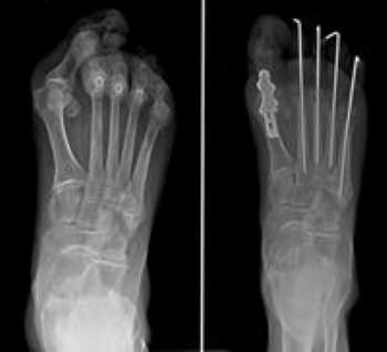 Arthritis of the Foot and Ankle - OrthoInfo - AAOS