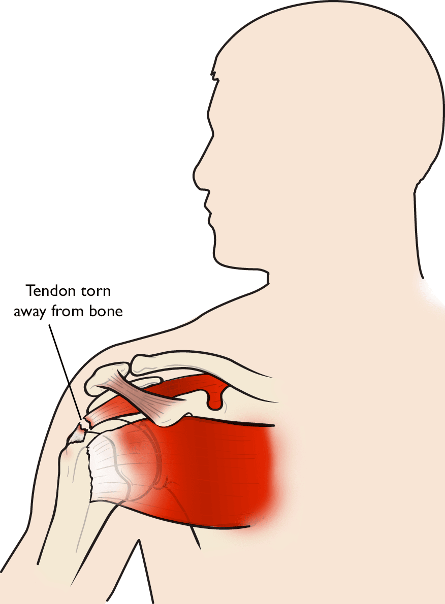 Torn rotator on sale cuff symptoms